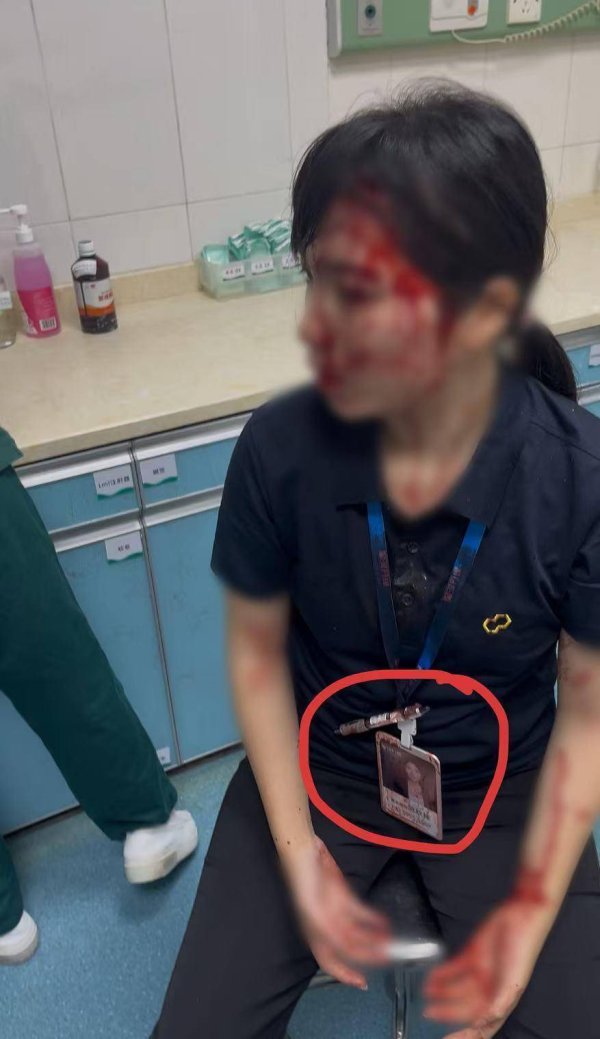 盛宝策略 “男子持水杯砸伤女同事被刑拘”后续：脸部缝20多针的女子已出院